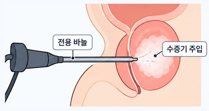 리줌 시술 3단계 — 수증기 주입