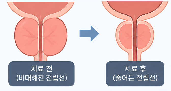 리줌 시술 4단계 — 치료 조직의 점진적 감소
